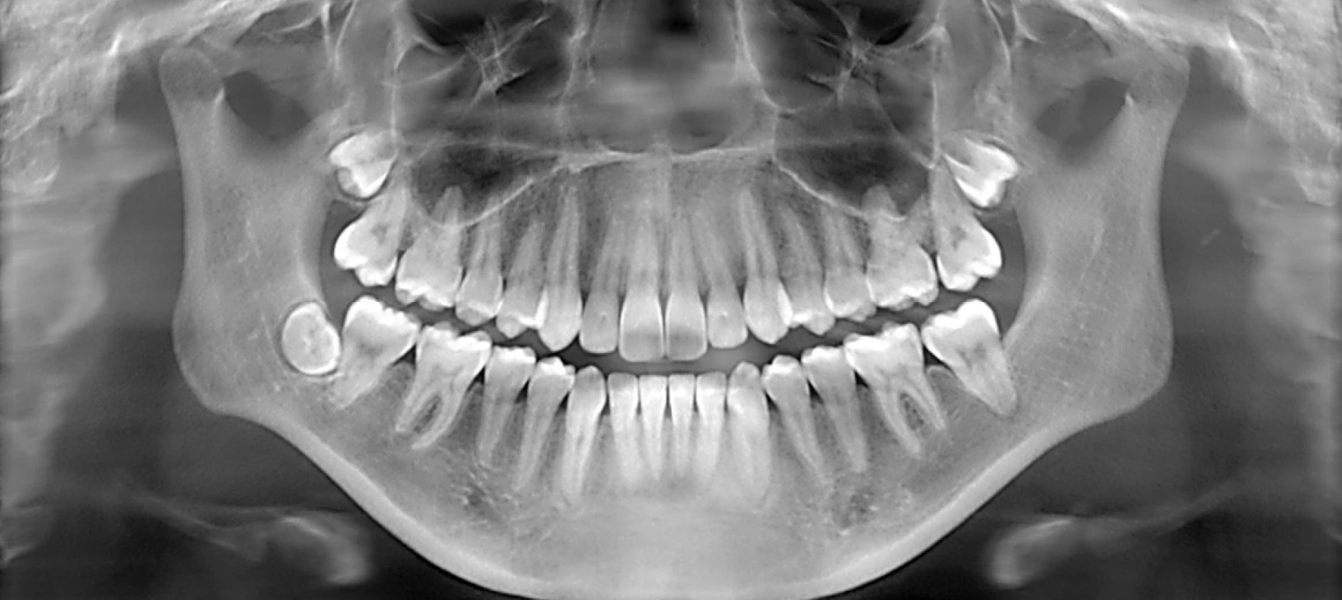 Nou versus Vechi. Radiografiile dentare digitale - mai putine radiatii decat un zbor Bucuresti-Paris