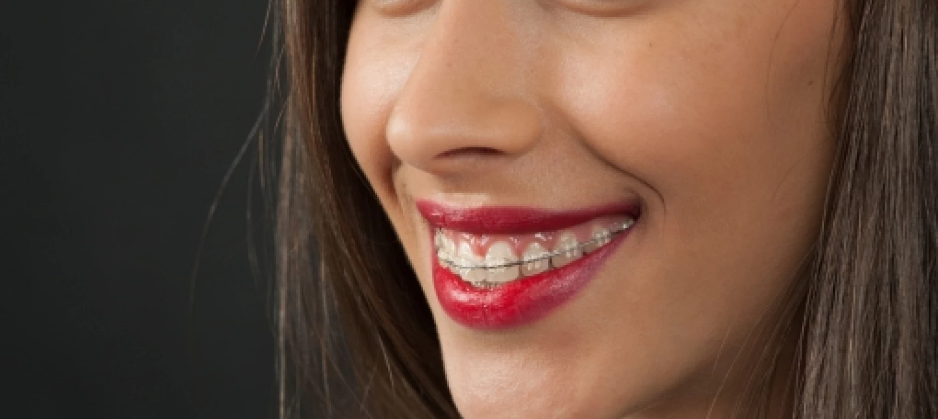 Cum se mentin rezultatele unui tratament ortodontic?