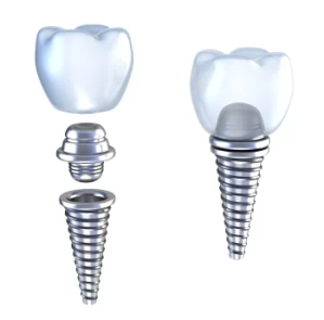 Implantul dentar si Osteointegrarea implantului