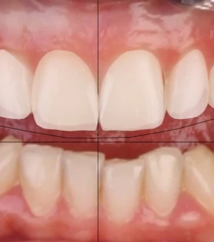 Digital Smile Design, Perfectionare continua NeoClinique