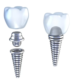 Implantul dentar si Osteointegrarea implantului