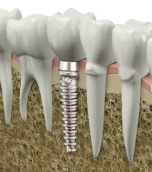 Implantul Dentar si CT-ul 