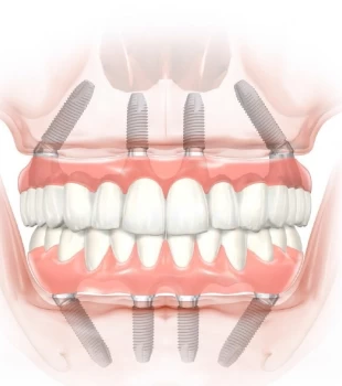 Reabilitarea danturii cu sistemul de implanturi dentare All on 4 si All on 6
