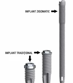 Implantul zigomatic - Solutia reabilitarilor dentare complicate
