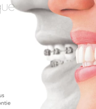 Tipuri de Aparate Ortodontice - Dr. Irimia Marius, Specialist Ortodontie