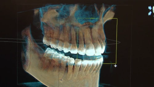 Tomografie dentara 3D