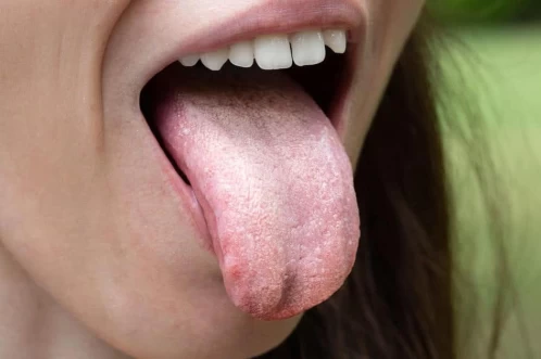 Candidoza bucală: cauze, simptome, tratament