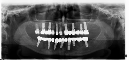 Rezectie apicala, tratamentul granulomului dentar
