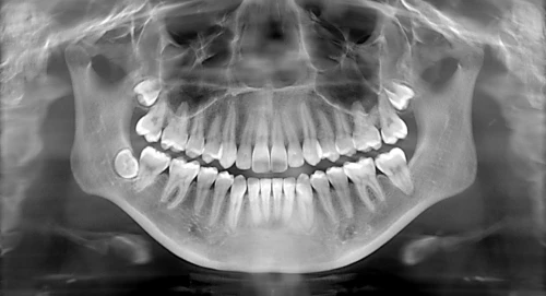 Nou versus Vechi. Radiografiile dentare digitale - mai putine radiatii decat un zbor Bucuresti-Paris