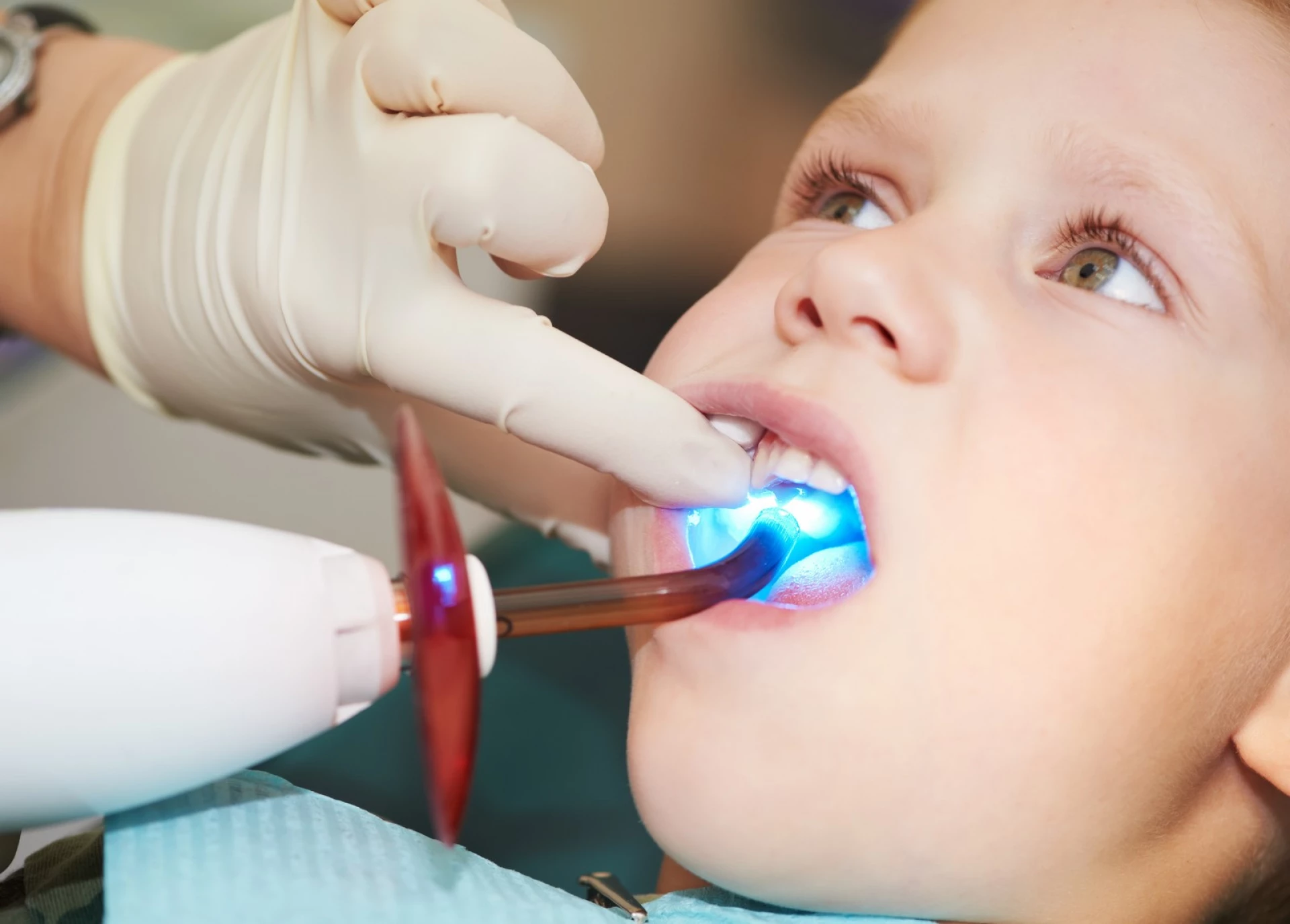 Sigilarea dentară este necesară pentru copii?