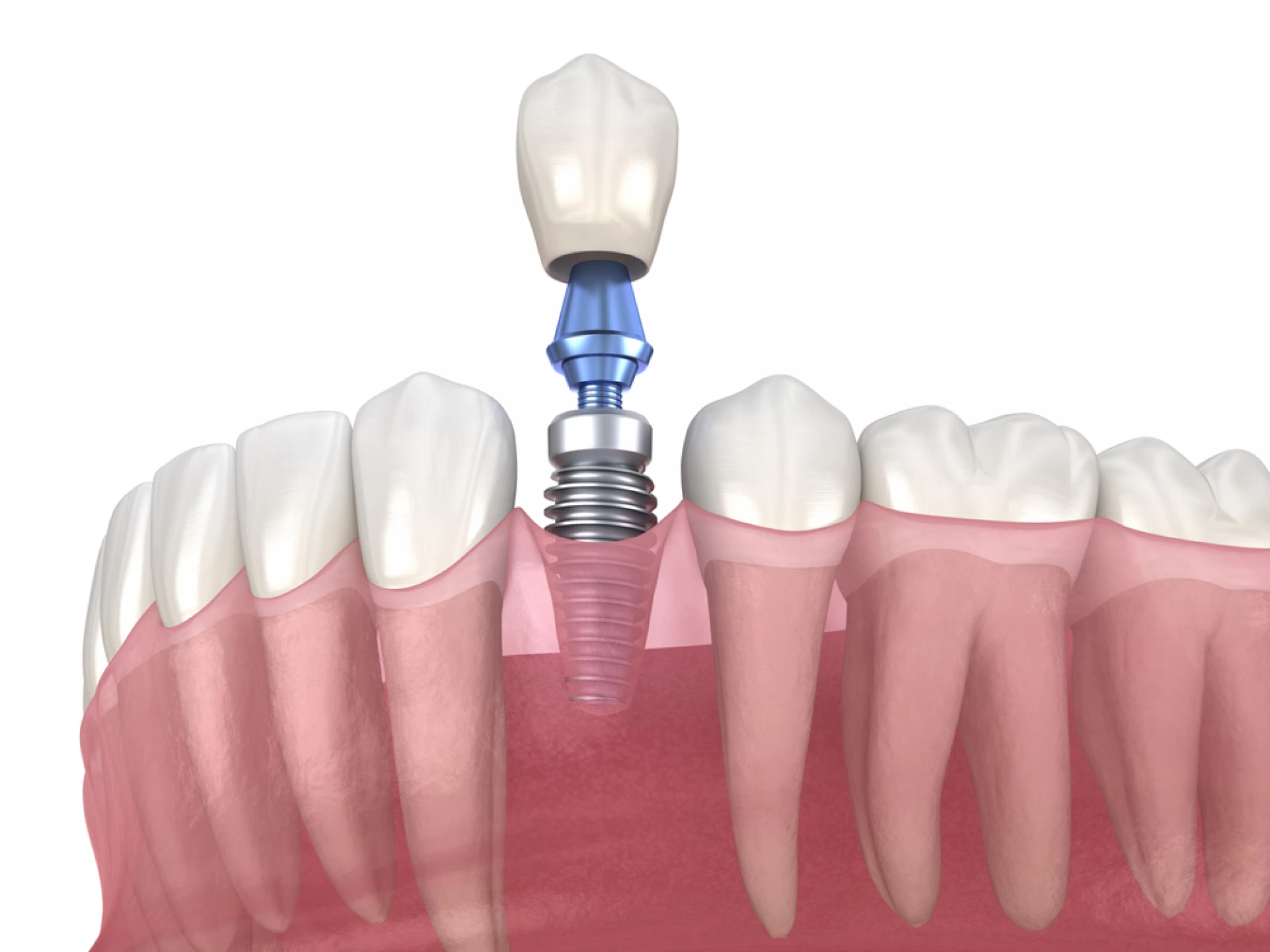 Implant dentar într-o zi