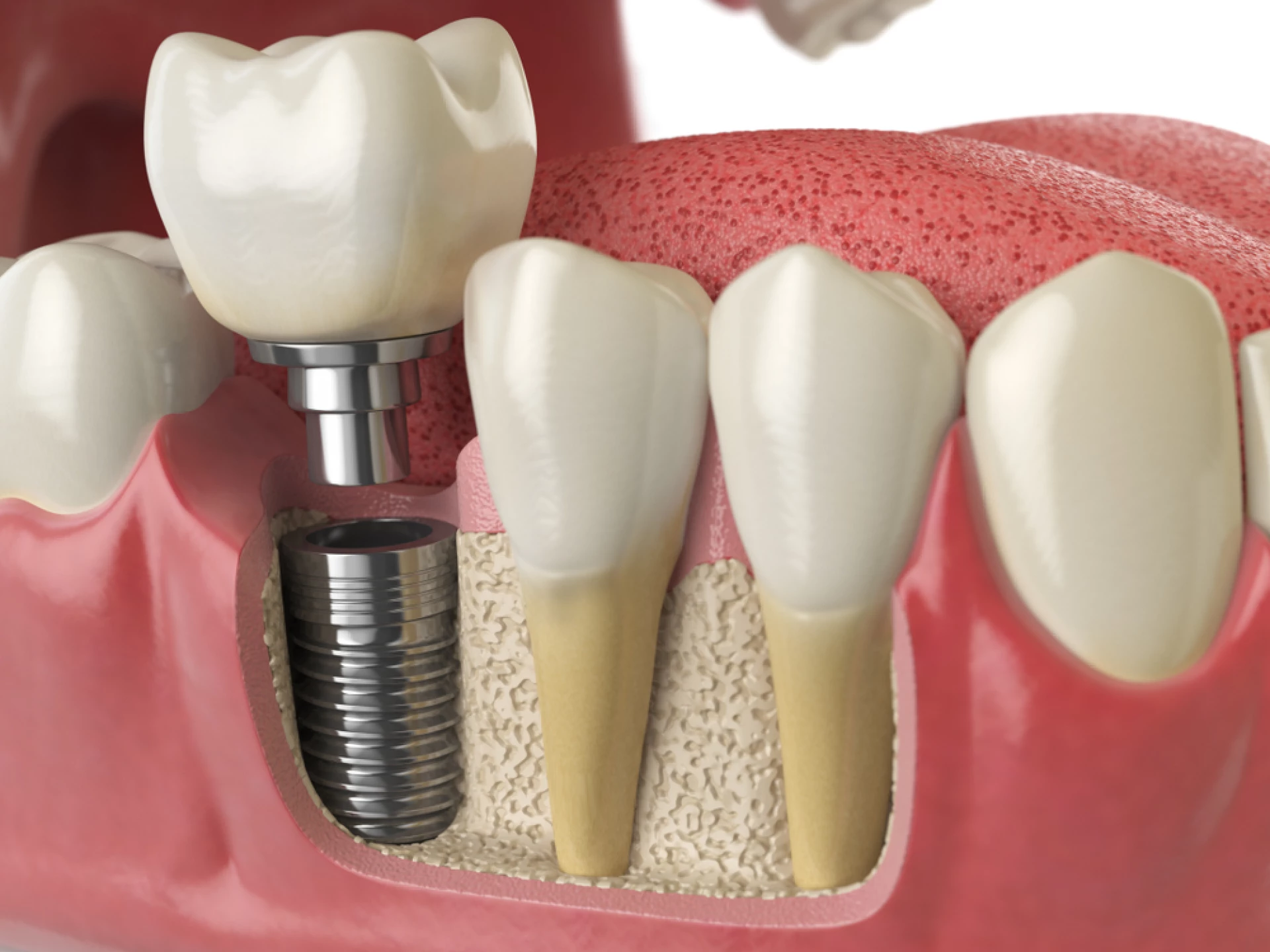Cât costă un implant dentar?