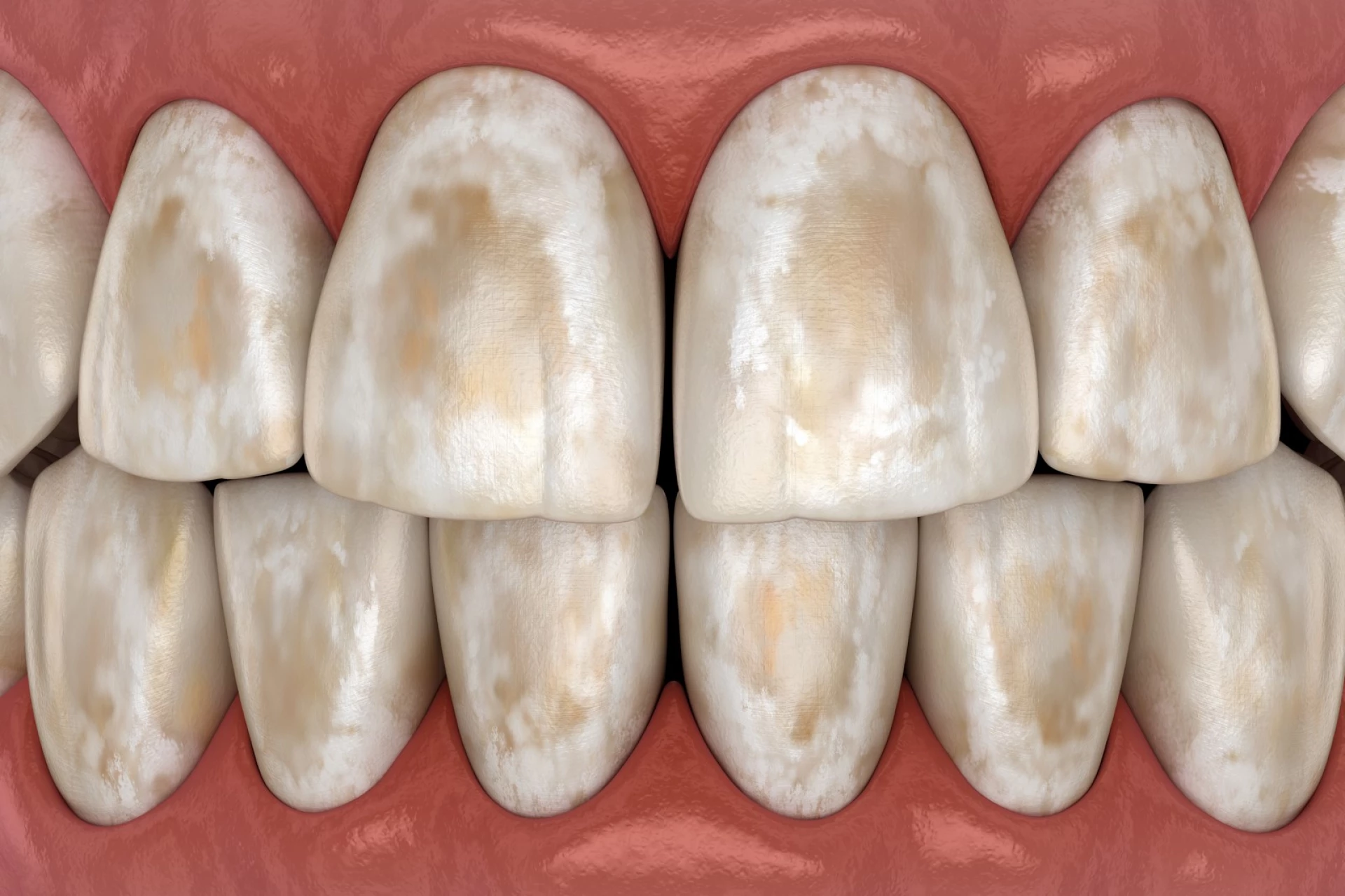 Demineralizarea dentară