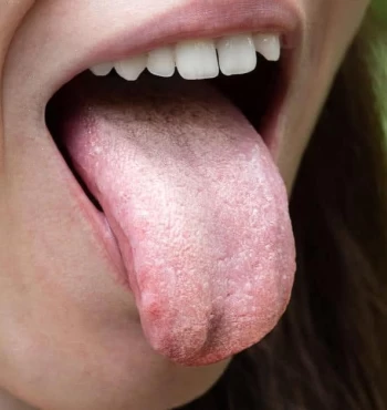 Candidoza bucală: cauze, simptome, tratament