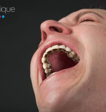 Aparatul dentar lingual Incognito