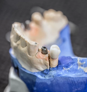 Implant dentar sau punte dentara ? Care este cea mai buna solutie?