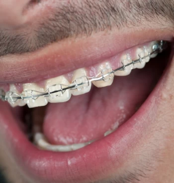 Ce este un aparat ortodontic fix?