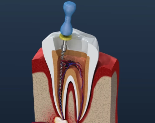 Tratament de canal (endodonție)
