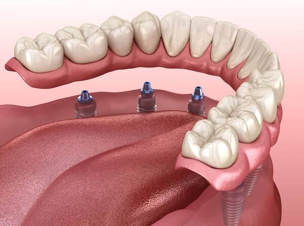 Ce este și în ce constă implantul dentar
